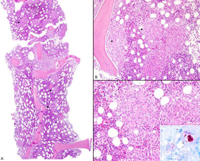 Fever of Unknown Origin, Wasting Syndrome and Bone Marrow Involvement: A Leprosy Case Report